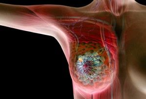 breast princ_rf_photo_of_breast_cancer_illustration