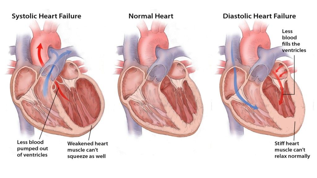 SystolicDiastolic_Heartfailure.5518685646fab