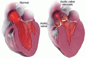 aortic_stenosis