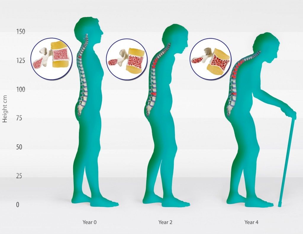 οστOsteoporosis-Stages