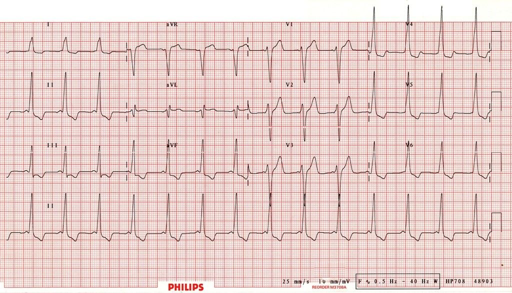 WPW b-ecg-005