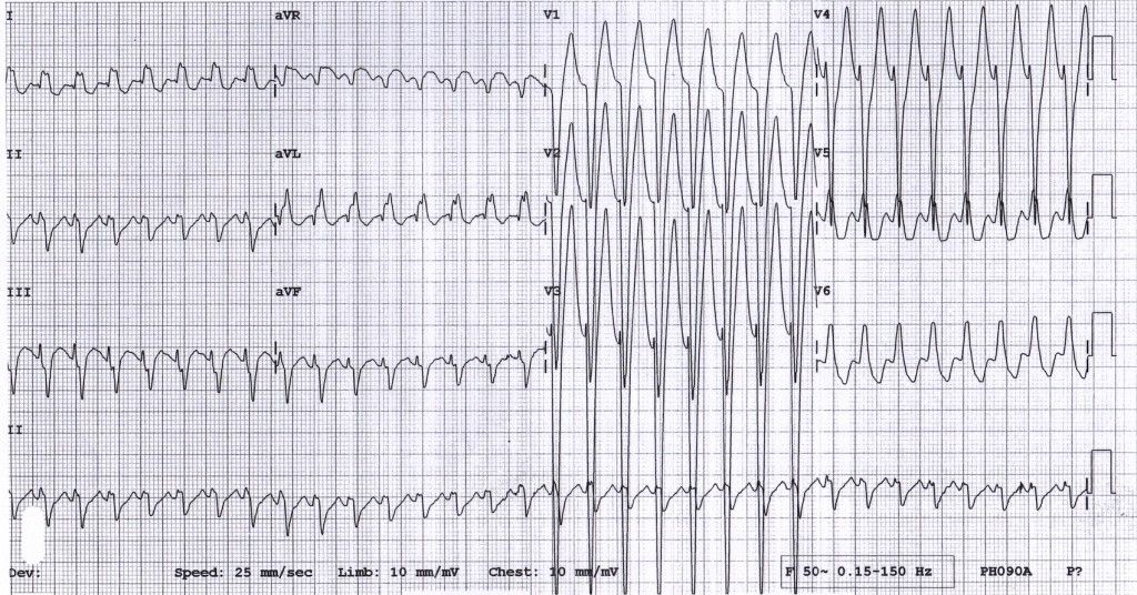 antidromic avrt WPW-AVRT-15yo-boy1