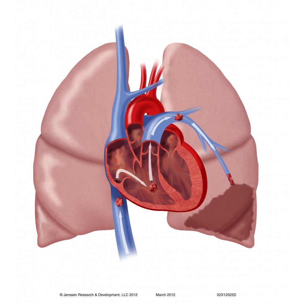 vte 54680-Pulmonary-Embolism-original