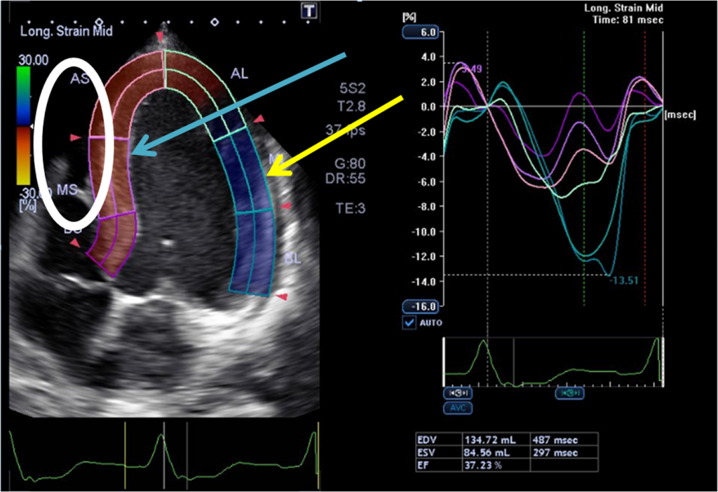 lbb Apical speckle track still pic-arrows