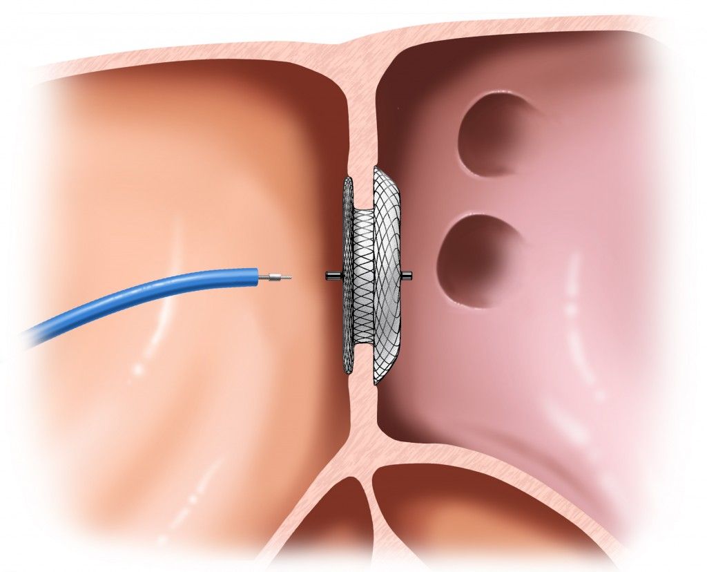 pfo ch6664.fig2